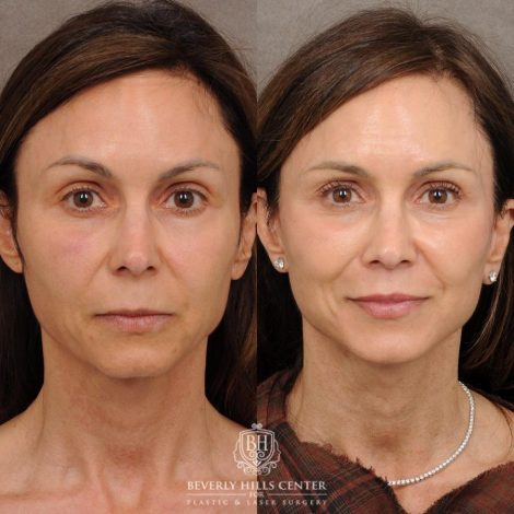 Beverly Hills Center Female Patient Before and After AuraLyft, Cupid Lift®, Upper Blepharoplasty, Nanofat