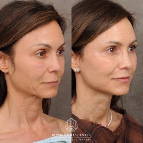 Beverly Hills Center Female Patient Before and After AuraLyft, Cupid Lift®, Upper Blepharoplasty, Nanofat