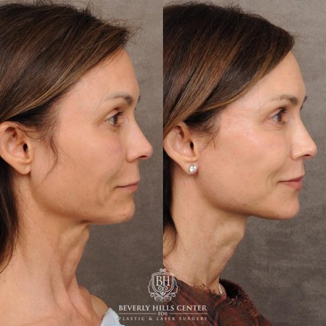 Beverly Hills Center Female Patient Before and After AuraLyft, Cupid Lift®, Upper Blepharoplasty, Nanofat