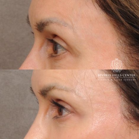 Beverly Hills Center Female Patient Before and After AuraLyft, Cupid Lift®, Upper Blepharoplasty, Nanofat