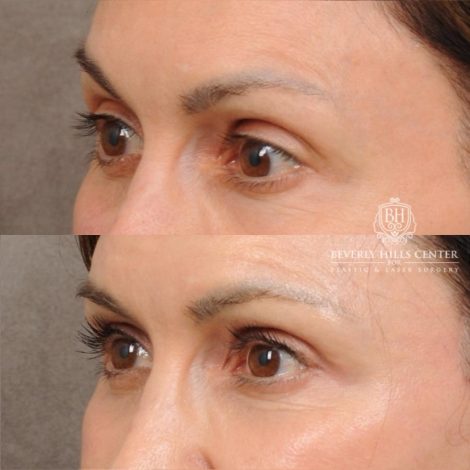 Beverly Hills Center Female Patient Before and After AuraLyft, Cupid Lift®, Upper Blepharoplasty, Nanofat