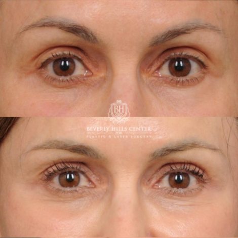 Beverly Hills Center Female Patient Before and After AuraLyft, Cupid Lift®, Upper Blepharoplasty, Nanofat