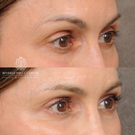 Beverly Hills Center Female Patient Before and After AuraLyft, Cupid Lift®, Upper Blepharoplasty, Nanofat