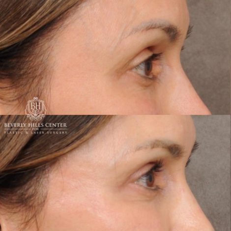 Beverly Hills Center Female Patient Before and After AuraLyft, Cupid Lift®, Upper Blepharoplasty, Nanofat