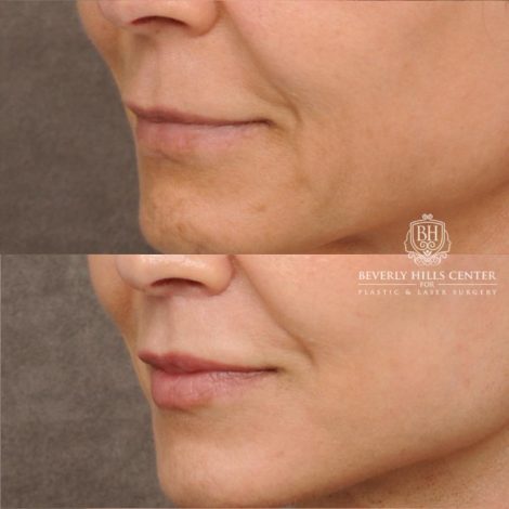 Beverly Hills Center Female Patient Before and After AuraLyft, Cupid Lift®, Upper Blepharoplasty, Nanofat