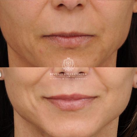 Beverly Hills Center Female Patient Before and After AuraLyft, Cupid Lift®, Upper Blepharoplasty, Nanofat