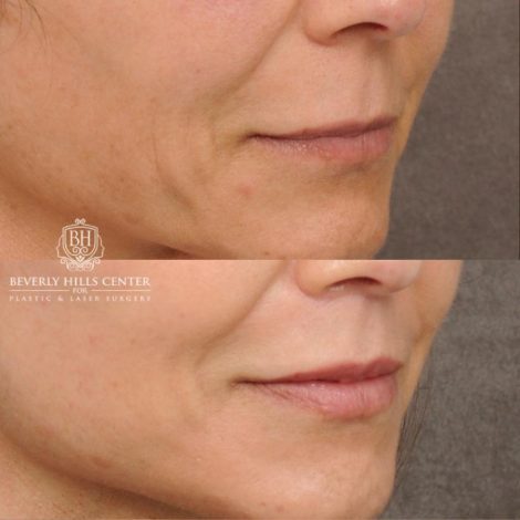 Beverly Hills Center Female Patient Before and After AuraLyft, Cupid Lift®, Upper Blepharoplasty, Nanofat