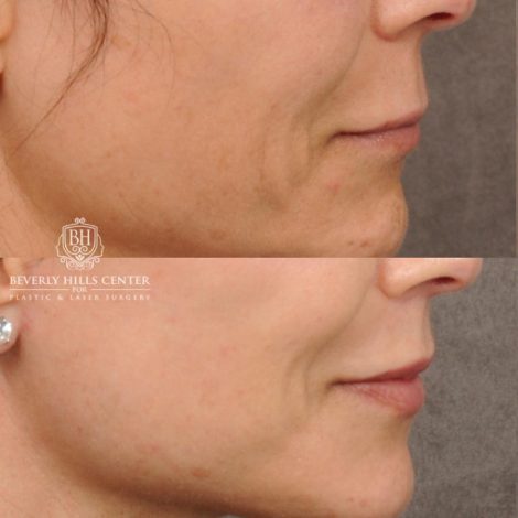 Beverly Hills Center Female Patient Before and After AuraLyft, Cupid Lift®, Upper Blepharoplasty, Nanofat