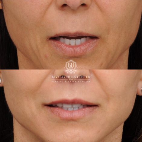 Beverly Hills Center Female Patient Before and After AuraLyft, Cupid Lift®, Upper Blepharoplasty, Nanofat