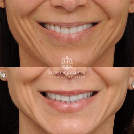 Beverly Hills Center Female Patient Before and After AuraLyft, Cupid Lift®, Upper Blepharoplasty, Nanofat