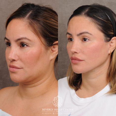 Beverly Hills Center Female Patient Before and After FACE & NECK and WEEKEND NECKLIFT