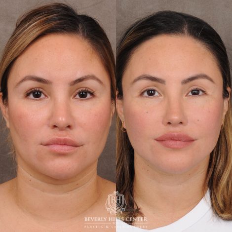 Beverly Hills Center Female Patient Before and After FACE & NECK and WEEKEND NECKLIFT