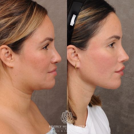 Beverly Hills Center Female Patient Before and After FACE & NECK and WEEKEND NECKLIFT