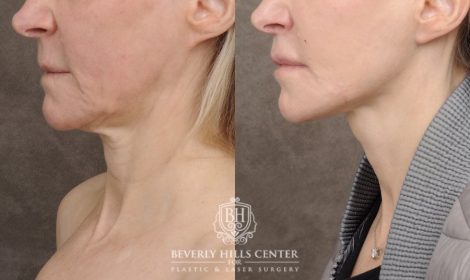 Beverly Hills Center Female Patient Before and After AuraLyft, Cupid Lift®, Upper Blepharoplasty, PHAT Face