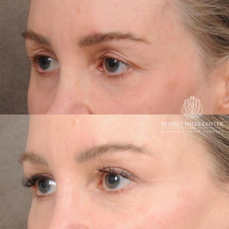 Beverly Hills Center Female Patient Before and After AuraLyft, Cupid Lift®, Upper Blepharoplasty, PHAT Face