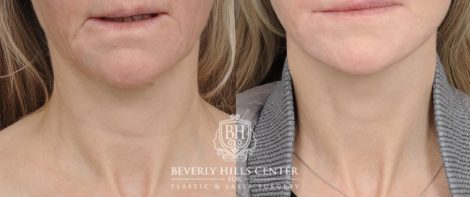 Beverly Hills Center Female Patient Before and After AuraLyft, Cupid Lift®, Upper Blepharoplasty, PHAT Face