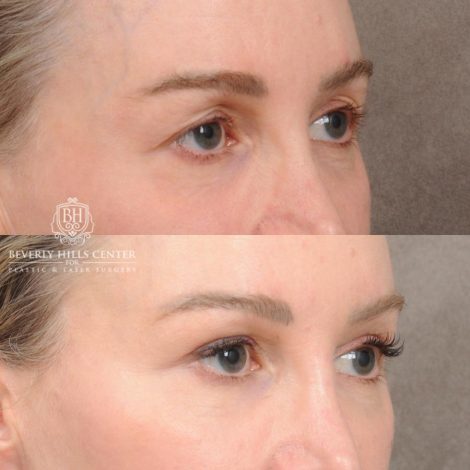 Beverly Hills Center Female Patient Before and After AuraLyft, Cupid Lift®, Upper Blepharoplasty, PHAT Face