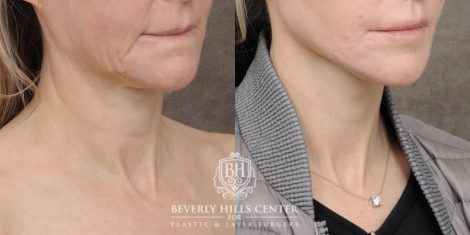 Beverly Hills Center Female Patient Before and After AuraLyft, Cupid Lift®, Upper Blepharoplasty, PHAT Face
