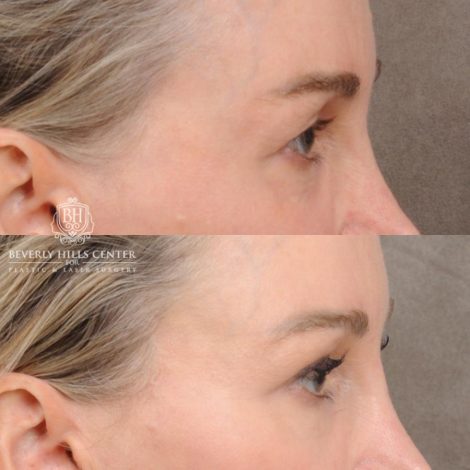 Beverly Hills Center Female Patient Before and After AuraLyft, Cupid Lift®, Upper Blepharoplasty, PHAT Face