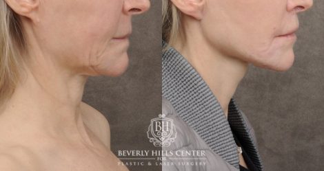 Beverly Hills Center Female Patient Before and After AuraLyft, Cupid Lift®, Upper Blepharoplasty, PHAT Face