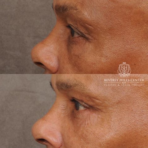 Beverly Hills Center Male Patient Before and After Upper & Lower Blepharoplasty