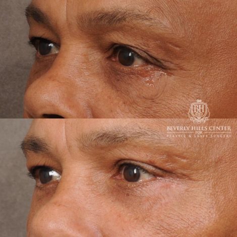 Beverly Hills Center Male Patient Before and After Upper & Lower Blepharoplasty
