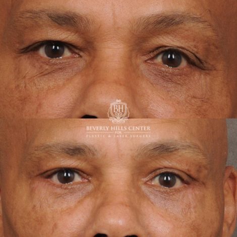 Beverly Hills Center Male Patient Before and After Upper & Lower Blepharoplasty