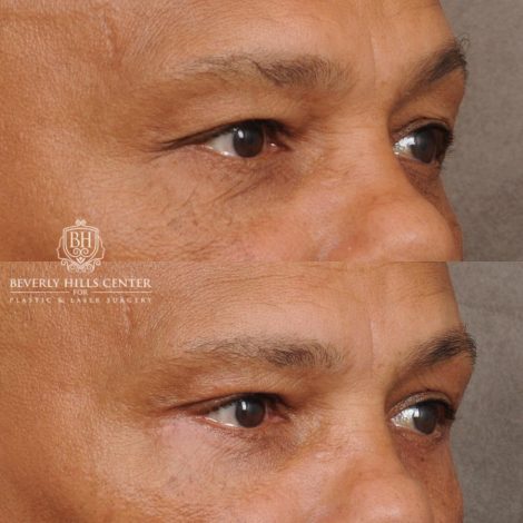 Beverly Hills Center Male Patient Before and After Upper & Lower Blepharoplasty