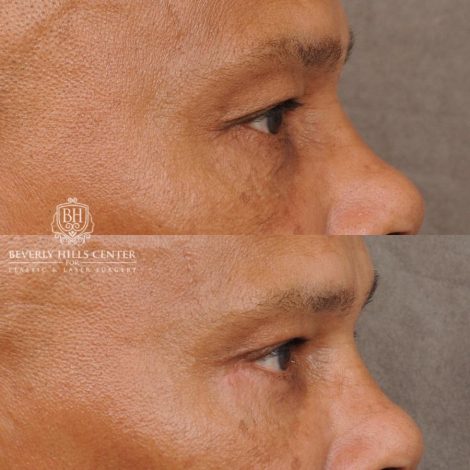 Beverly Hills Center Male Patient Before and After Upper & Lower Blepharoplasty