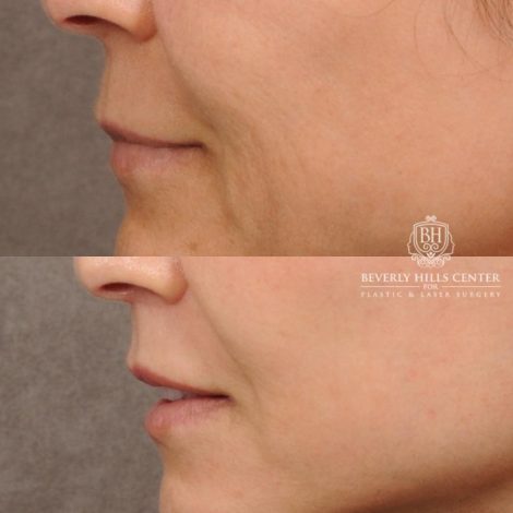 Beverly Hills Center Female Patient Before and After AuraLyft, Cupid Lift®, Upper Blepharoplasty, Nanofat