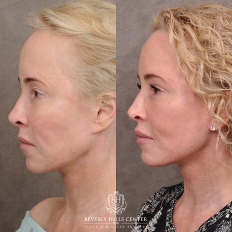Beverly Hills Center Female Patient Before and After AuraLyft, Cupid Lift® and Eye & Brow Lift