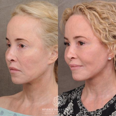 Beverly Hills Center Female Patient Before and After AuraLyft, Cupid Lift® and Eye & Brow Lift