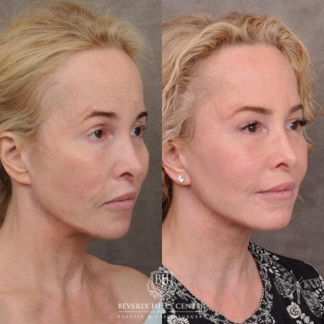 Beverly Hills Center Female Patient Before and After AuraLyft, Cupid Lift® and Eye & Brow Lift