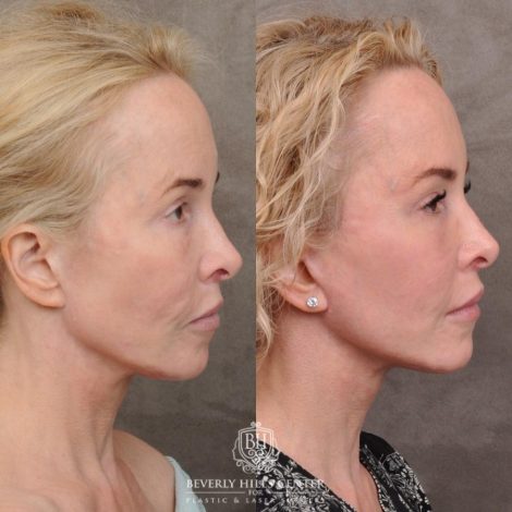 Beverly Hills Center Female Patient Before and After AuraLyft, Cupid Lift® and Eye & Brow Lift