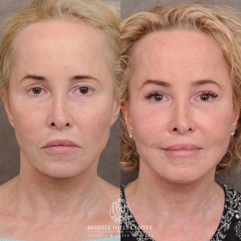 Beverly Hills Center Female Patient Before and After AuraLyft, Cupid Lift® and Eye & Brow Lift