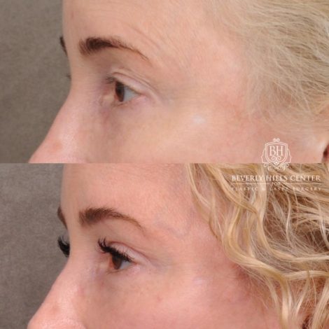 Beverly Hills Center Female Patient Before and After AuraLyft, Cupid Lift® and Eye & Brow Lift
