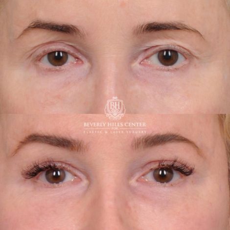 Beverly Hills Center Female Patient Before and After AuraLyft, Cupid Lift® and Eye & Brow Lift