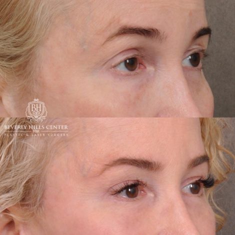 Beverly Hills Center Female Patient Before and After AuraLyft, Cupid Lift® and Eye & Brow Lift