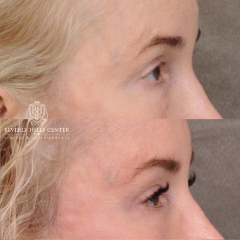 Beverly Hills Center Female Patient Before and After AuraLyft, Cupid Lift® and Eye & Brow Lift