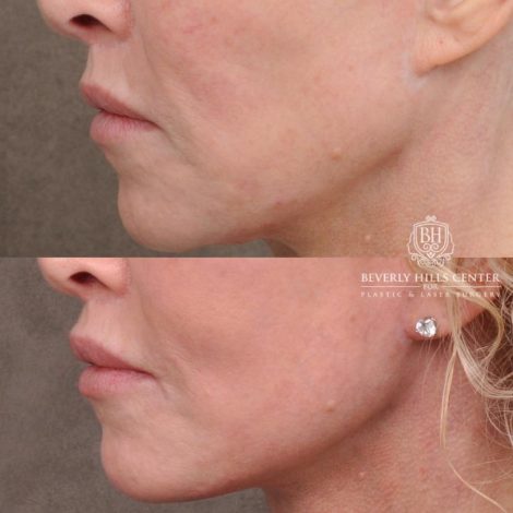 Beverly Hills Center Female Patient Before and After AuraLyft, Cupid Lift® and Eye & Brow Lift