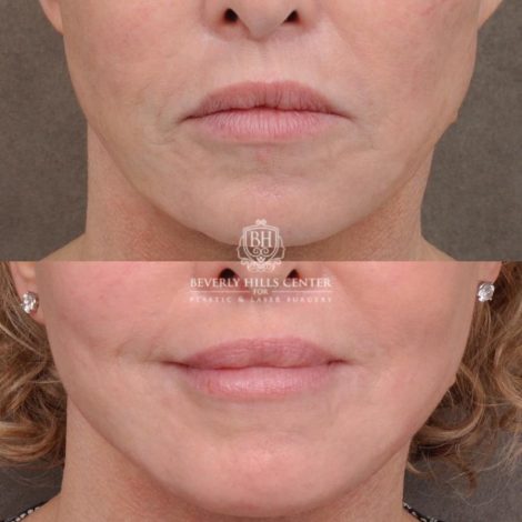 Beverly Hills Center Female Patient Before and After AuraLyft, Cupid Lift® and Eye & Brow Lift