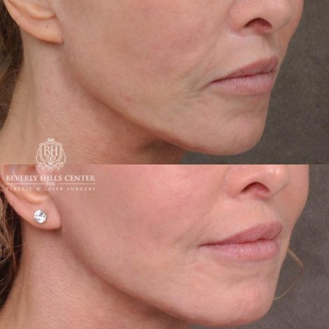 Beverly Hills Center Female Patient Before and After AuraLyft, Cupid Lift® and Eye & Brow Lift