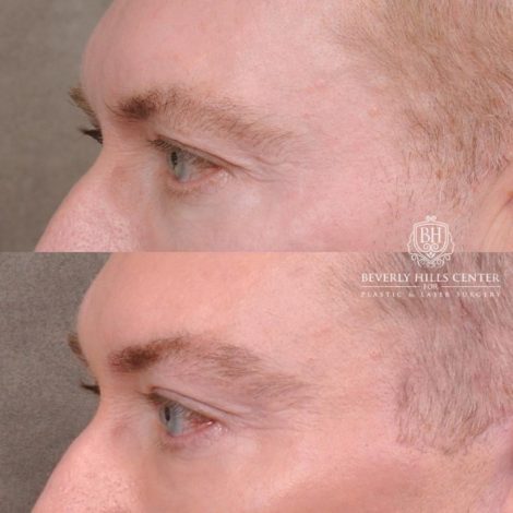 Beverly Hills Center Male Patient Before and After AuraLyft and Eye & Brow Lift