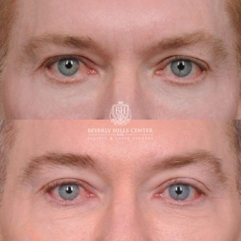Beverly Hills Center Male Patient Before and After AuraLyft and Eye & Brow Lift