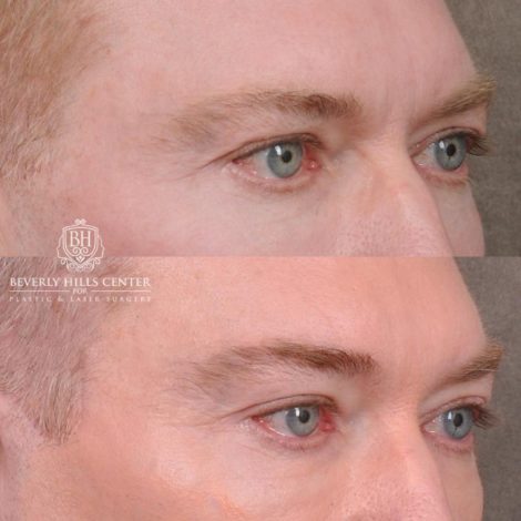 Beverly Hills Center Male Patient Before and After AuraLyft and Eye & Brow Lift