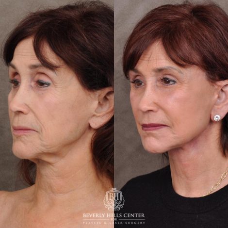 Beverly Hills Center Female Patient Before and After AuraLyft and Eye & Brow Lift