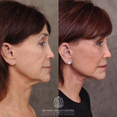 Beverly Hills Center Female Patient Before and After AuraLyft and Eye & Brow Lift