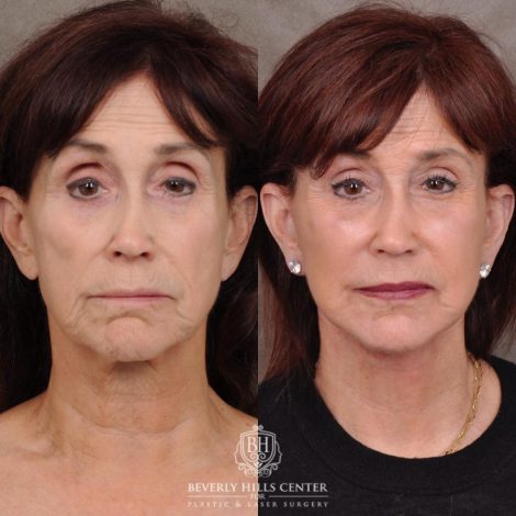 Beverly Hills Center Female Patient Before and After AuraLyft and Eye & Brow Lift