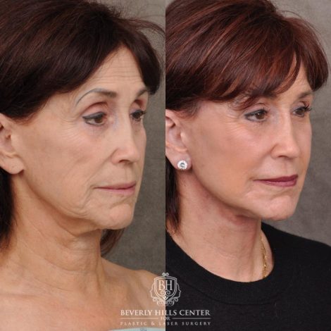 Beverly Hills Center Female Patient Before and After AuraLyft and Eye & Brow Lift