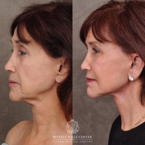 Beverly Hills Center Female Patient Before and After AuraLyft and Eye & Brow Lift